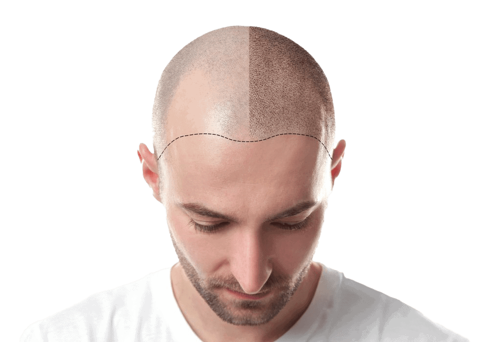 Hair Transplant Results - Before and After