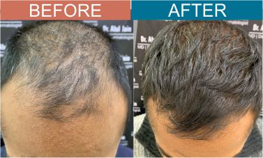 PRP-Threapy-for-Hair-Loss
