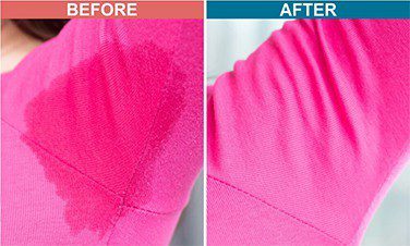 Botox-Treatment-For-Hyperhidrosis-Before-After-1
