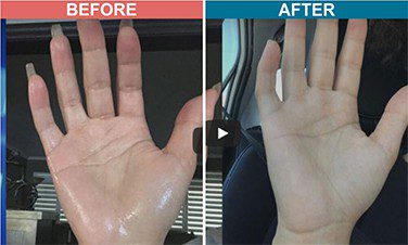 Botox-Treatment-For-Hyperhidrosis-Before-After-2