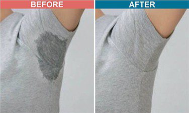 Botox-Treatment-For-Hyperhidrosis-Before-After-3