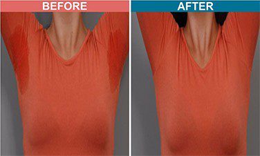 Botox-Treatment-For-Hyperhidrosis-Before-After-4