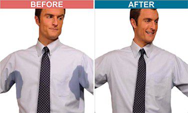Botox-Treatment-For-Hyperhidrosis-Before-After-5