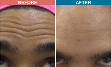 Botox-_-Fillers-Treatment-for-Anti-Aging-skinaa-clinic-before-after-1