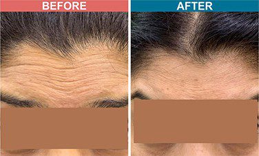 Botox-_-Fillers-Treatment-for-Anti-Aging-skinaa-clinic-before-after-3