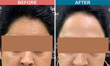 Botox-_-Fillers-Treatment-for-Anti-Aging-skinaa-clinic-before-after-4