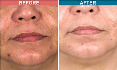 Carban-Laser-Facial-Treatment-For-Pigmentation-Before-After-Skinaa-Clinic-1