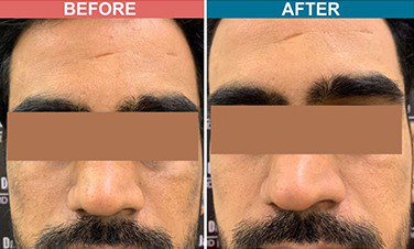 Carban-Laser-Facial-Treatment-For-Pigmentation-Before-After-Skinaa-Clinic-3