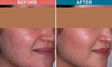 Carban-Laser-Facial-Treatment-For-Pigmentation-Before-After-Skinaa-Clinic-4