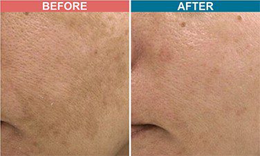 Carban-Laser-Facial-Treatment-For-Pigmentation-Before-After-Skinaa-Clinic-5