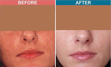 Carbon-Laser-Facial-Treatment-For-Skin-Lightenign_Whitening-Before-After-1