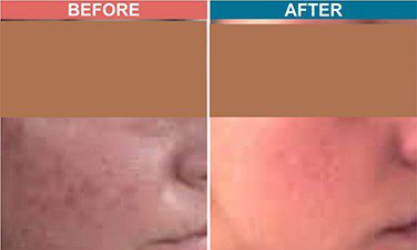 Carbon-Laser-Facial-Treatment-For-Skin-Lightenign_Whitening-Before-After-2