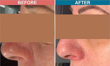 Carbon-Laser-Facial-Treatment-For-Skin-Lightenign_Whitening-Before-After-4