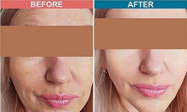Carbon-Laser-Facial-Treatment-For-Skin-Lightenign_Whitening-Before-After-5