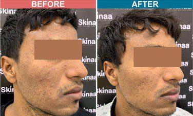 Chemical-Peel-Treatment-For-Pigmentation-Before-After-Skinaa-Clinic-1