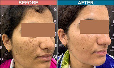 Chemical-Peel-Treatment-For-Pigmentation-Before-After-Skinaa-Clinic-2