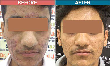 Chemical-Peel-Treatment-For-Pigmentation-Before-After-Skinaa-Clinic-3