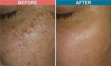Chemical-Peel-Treatment-For-Pigmentation-Before-After-Skinaa-Clinic-4