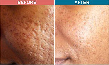 Darmaroller-Treatment-For-Acne-Scar-Before-after-Skinaa-clinic-1
