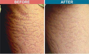 Darmaroller-Treatment-For-Acne-Scar-Before-after-Skinaa-clinic-2