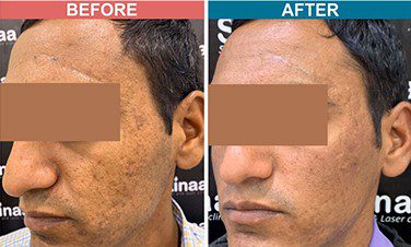 Darmaroller-Treatment-For-Acne-Scar-Before-after-Skinaa-clinic-3