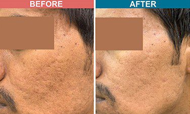 Darmaroller-Treatment-For-Acne-Scar-Before-after-Skinaa-clinic-4