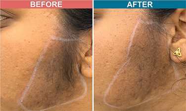 Diode-Laser-Treatment-For-Hair-Removal-before-after-skinaa-clinic-1
