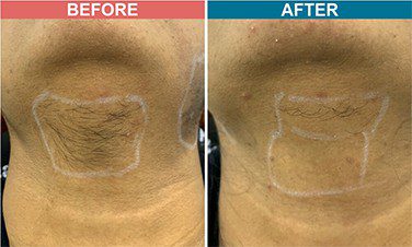 Diode-Laser-Treatment-For-Hair-Removal-before-after-skinaa-clinic-2