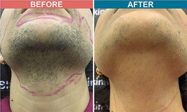 Laser Hair Removal in Jaipur | Diode Laser Hair Removal Cost in Jaipur