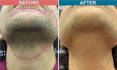 Laser Hair Removal in Jaipur Diode Laser Hair Removal Cost in Jaipur