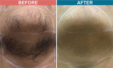 Diode-Laser-Treatment-For-Hair-Removal-before-after-skinaa-clinic-4