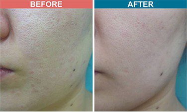 ERBM-FIBER-Treatment-For-Acne-Scar-Before-After-Skinaa-clinic-1