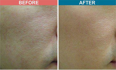 ERBM-FIBER-Treatment-For-Acne-Scar-Before-After-Skinaa-clinic-2