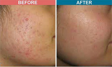 ERBM-FIBER-Treatment-For-Acne-Scar-Before-After-Skinaa-clinic-4