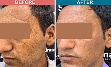 ERBM-FIBER-Treatment-For-Acne-Scar-Before-After-Skinaa-clinic-5