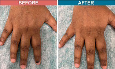 Excimer-Laser-Treatment-For-Vitiligo-Skinaa-Clinic-Before-After-2 (1)