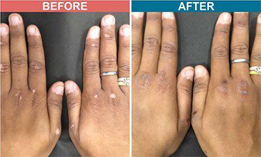 Excimer-Laser-Treatment-For-Vitiligo-Skinaa-Clinic-Before-After-3