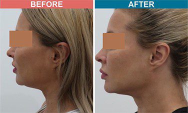 Fillers-Treatment-for-Anti-Aging-skinaa-clinic-Before-After-1