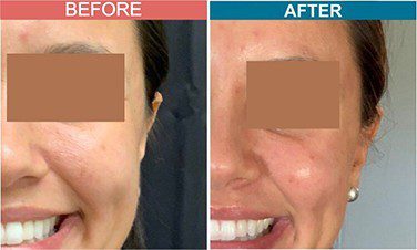 Fillers-Treatment-for-Anti-Aging-skinaa-clinic-Before-After-2