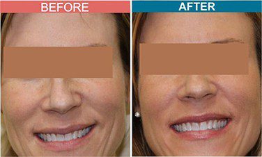 Fillers-Treatment-for-Anti-Aging-skinaa-clinic-Before-After-3