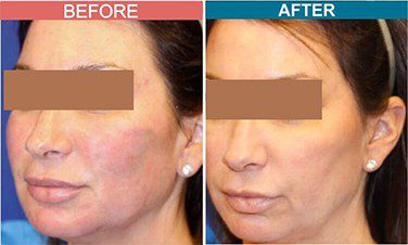 Fillers-Treatment-for-Anti-Aging-skinaa-clinic-Before-After-4