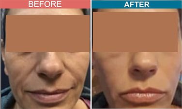 Fillers-Treatment-for-Anti-Aging-skinaa-clinic-Before-After-5