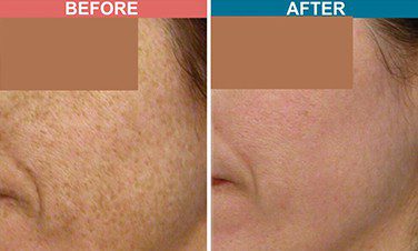 Fractional-CO2-Laser-Treatment-For-Acne-Scar-Skinaa-Clinic-before-after-1 (1)