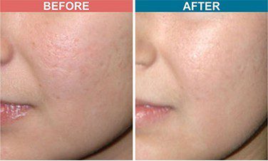 Fractional-CO2-Laser-Treatment-For-Acne-Scar-Skinaa-Clinic-before-after-2
