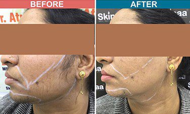 IPL-Laser-Treament-For-Hair-Removal-Befor-After-2