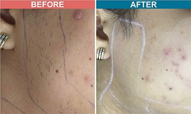 IPL-Laser-Treament-For-Hair-Removal-Befor-After-3