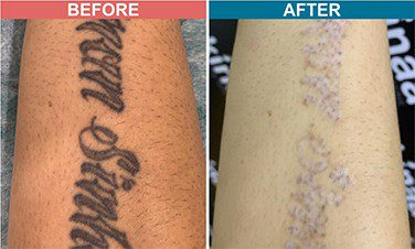 Tattoo Removal At Lynx Hair Skin Clinic our  LYNX Hair Skin Clinic