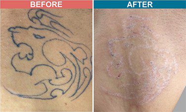 Laser-Tattoo-Removal-Skinaa-Clinic-Before-After-2