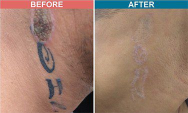 Laser-Tattoo-Removal-Skinaa-Clinic-Before-After-3