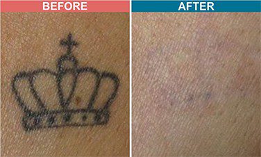 Laser-Tattoo-Removal-Skinaa-Clinic-Before-After-4